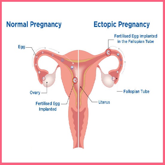 Ectopic Pregnancy Treatment in Ghaziabad Noida