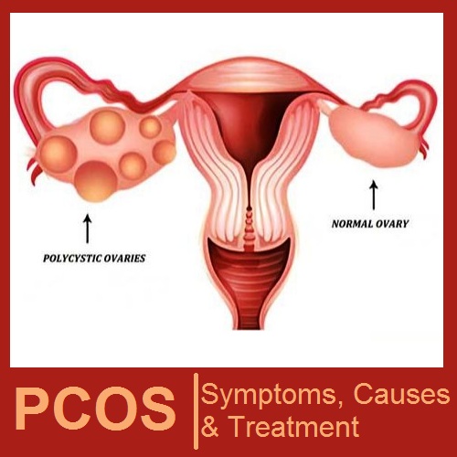 Best Treatment of PCOS/PCOD in Ghaziabad and Noida Extension