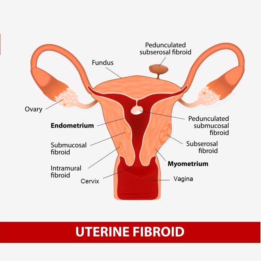 Best Treatment of Fibroids in Ghaziabad and Noida Extension